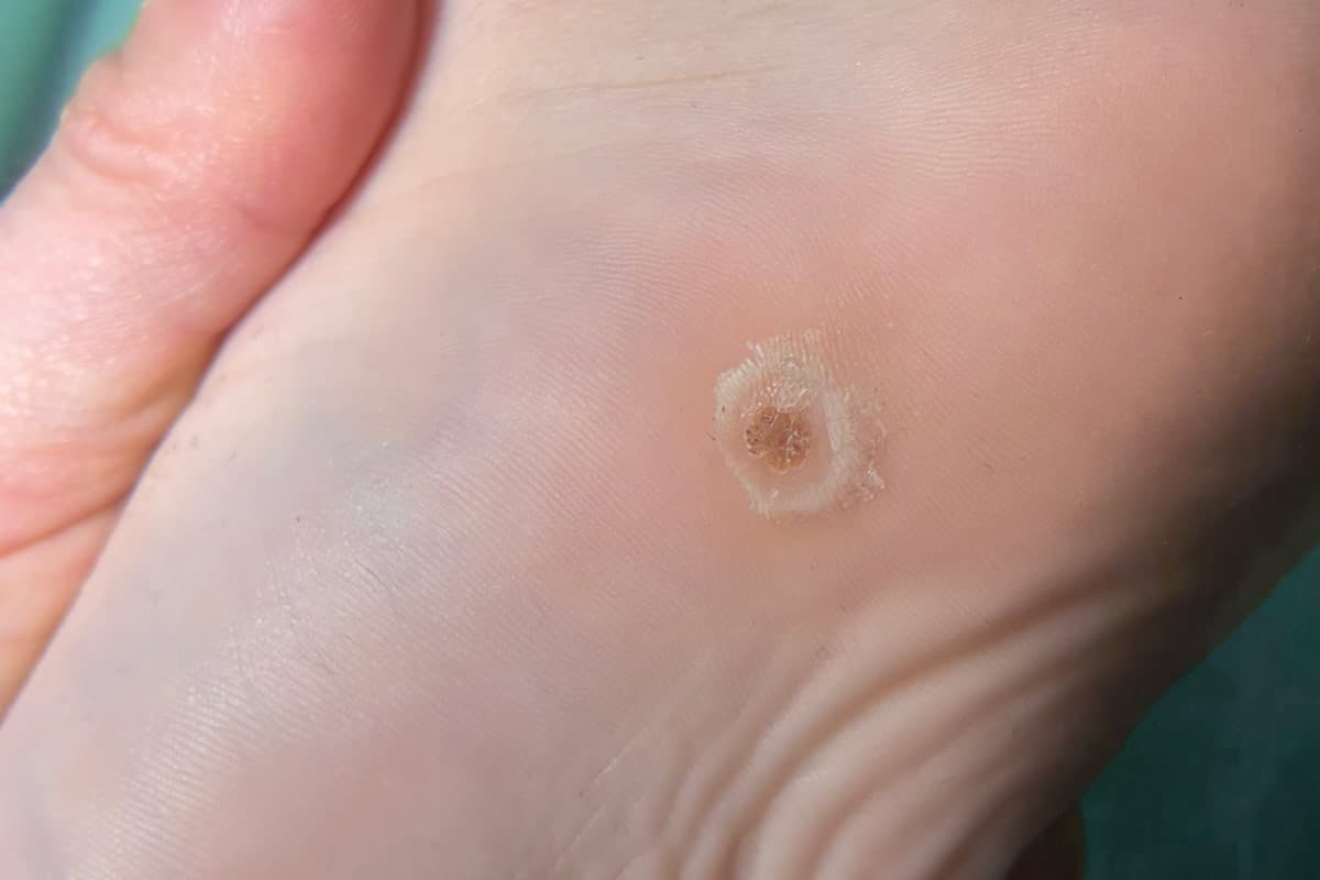 Verrugas plantares